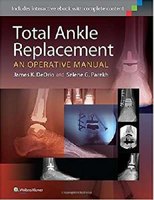 Total Ankle Replacement: An Operative Manual