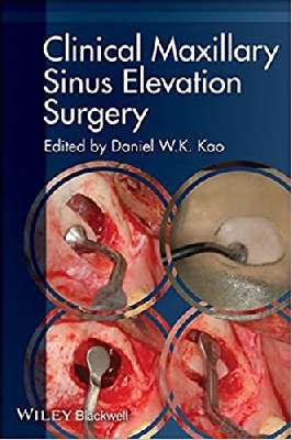 Clinical  Maxillary Sinus Elevation  Surgery
