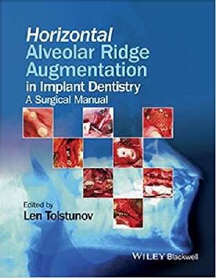 Horizontal alveolar ridge augmentation in implant dentistry: a surgical manual