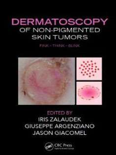 Dermatoscopy of Non-Pigmented Skin Tumors