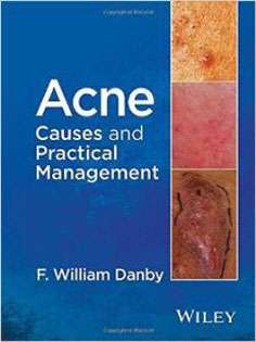 Acne Causes and Practical Management