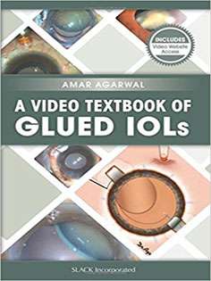 A Video Textbook of Glued IOLs
