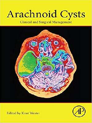 Arachnoid Cysts: Clinical and Surgical Management