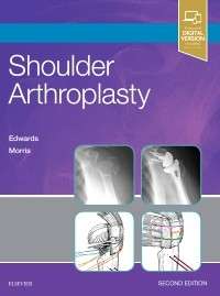 Shoulder Arthroplasty