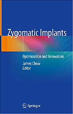 Zygomatic Implants